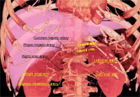 3D-rendered computed tomography, showing one renal vein (in red color) for each kidney