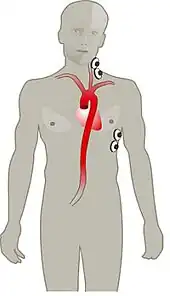 Electrode array that measures Thoracic electrical bioimpedance (TEB)