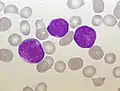 Acute lymphoblastic leukemia (ALL), peripheral blood of a child, Pappenheim stain, magnification x100