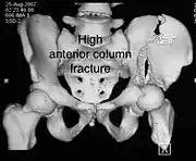 High anterior column fracture 3 D CT scan picture