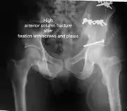 High anterior column fracture after fixation with screws and plates