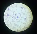 Acute myeloid leukemia