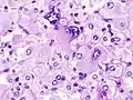 A pheochromocytoma showing finely granular chromatin. H&E stain.