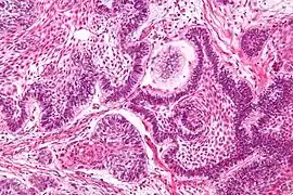 Ameloblastoma; Islands of cells with palisaded nuclei that have reverse polarization