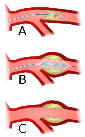 Angioplasty (pictured) and stenting are two endovascular treatments employed by the vascular surgeon.