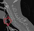 CT scan showing bamboo spine in ankylosing spondylitis