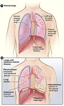 Figure A shows the location of the lungs, airways, pleura, and diaphragm in the body. Figure B shows lungs with asbestos-related diseases, including pleural plaque, lung cancer, asbestosis, plaque on the diaphragm, and mesothelioma.