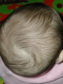 A hair whorl is a patch of hair growing in a circular direction around a visible center point.