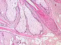 Base of pilosebaceous unit