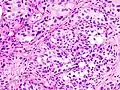 Histopathology of urothelial carcinoma of the urinary bladder.