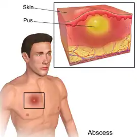 A diagram of an abscess