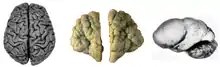 Normal human adult cerebrum (left), polymicrogyria (center) and lissencephaly (right).