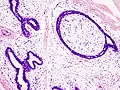 Fibroadenoma histology (H&E). The image demonstrates intracanalicular morphology (bottom left) and pericanalicular morphology (top right)