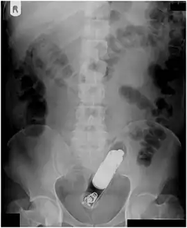 Vibrator stuck in the rectum can be seen on this abdominal X-ray.