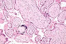 Micrograph of a placental infection (CMV placentitis)