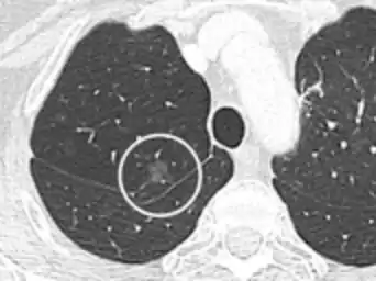 CT image showing ground-glass nodule (circled).