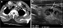 CT (L) and ultrasound (R) of thyroid colloid nodule with calcification