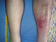 Infected left shin in comparison to the right-sided shin with no sign of symptoms.