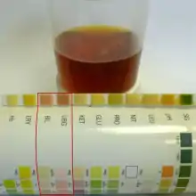 Dark red urine due to choluria.