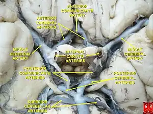 Basilar artery