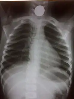 Chest radiograph showing a Venezuelan 25 cent coin lodged in the upper esophagus of a 9-year-old girl.