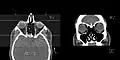 CT scan of the paranasal sinuses with coronal reconstruction (right) and axial planning data (left).