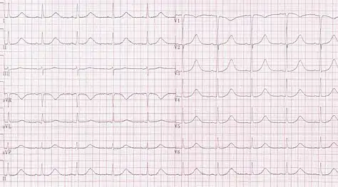 Long QT syndrome