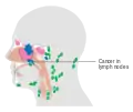 Ethmoid sinus cancer that has spread to the lymph nodes