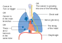 One option for stage IIB lung cancer, with T2b; but if tumor is within 2 cm of the carina, this is stage 3