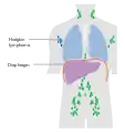 Stage 1 Hodgkin lymphoma