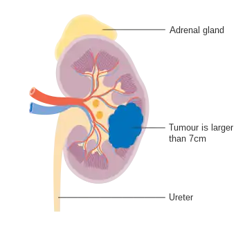 Stage 2 kidney cancer