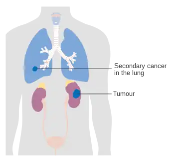 Stage 4 kidney cancer