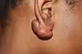 Earlobe keloid