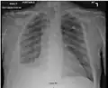 Fibrothorax and pleural effusion caused by silicosis