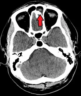 Frontal sinusitis