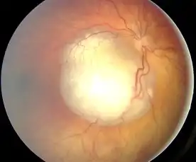 A fundus with retinoblastoma