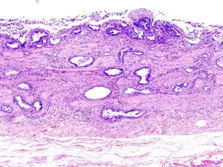 Incidentally discovered gallbladder cancer (adenocarcinoma) following a cholecystectomy.