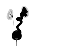 High grade vesico-ureteric reflux - easily mistaken for cystic renal disease on early scans