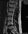 Example of a herniated disc at L5–S1 in the lumbar spine