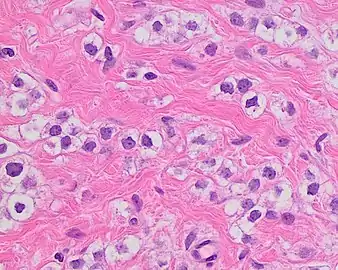 Invasive lobular carcinoma with moderate nuclear pleomorphism.