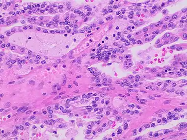 A micrograph of type 1 PRCC, illustrating features of small basophilic cells with scarce cytoplasm. A single layer of cells are surrounding the basal membrane. Foamy macrophages are inside of papillary fibrovascular cores.