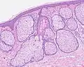 H&E staining of biopsied lesion of sebaceous hyperplasia: Note the multiple, mature sebaceous lobules attached to the central dilated duct in the upper dermis.