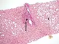 Histopathology of steatohepatitis with mild fibrosis in the form of fibrous expansion (Van Gieson's stain)