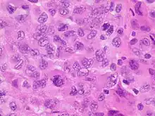 Anaplastic tumor cells.