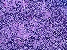 Hodgkin lymphoma, nodular lymphocyte predominant (high-power view): Notice the presence of L&H cells, also known as "popcorn cells". (H&E)