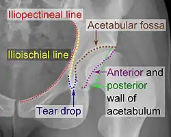 X-ray of the acetabulum, with measurements used in X-ray of hip dysplasia in adults.