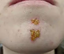 Impetigo