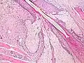 Insertion of sebaceous glands into hair shaft