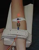 An intravenous blood irradiation therapy in use.