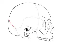 Lambdoid suture. It separates the parietal bones and the occipital bone.